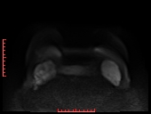File:Bilateral breast implant rupture (Radiopaedia 24761-25027 DWI 29).jpg