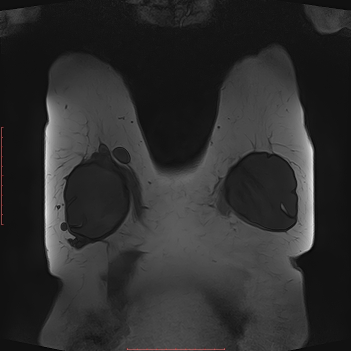 Bilateral breast implant rupture (Radiopaedia 24761-25027 G 56).jpg