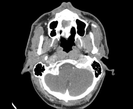 Bilateral carotid body tumors (Radiopaedia 61841-69870 Axial Post contrast 11).jpg