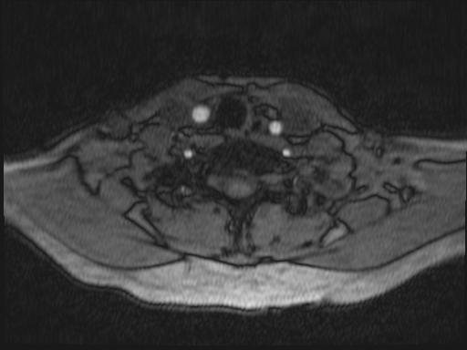 Bilateral carotid body tumors and right glomus jugulare tumor (Radiopaedia 20024-20060 Axial MRA 199).jpg