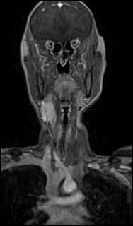 File:Bilateral carotid body tumors and right glomus jugulare tumor (Radiopaedia 20024-20060 MRA 11).jpg