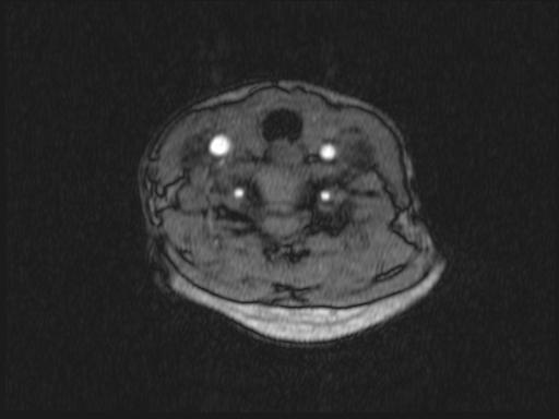 File:Bilateral carotid body tumors and right jugular paraganglioma (Radiopaedia 20024-20060 Axial 334).jpg