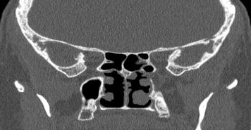 File:Bilateral ectopic infraorbital nerves (Radiopaedia 49006-54084 Coronal 8).png
