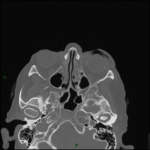 File:Bilateral frontal mucoceles (Radiopaedia 82352-96454 Axial bone window 162).jpg