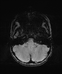 Bilateral mesial temporal polymicrogyria (Radiopaedia 76456-88181 Axial SWI 9).jpg