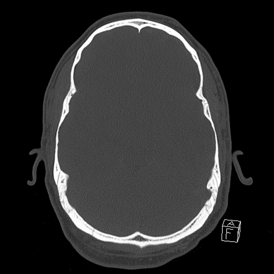 Bilateral occipital condyle fracture (type 2) (Radiopaedia 87675-104089 Axial bone window 53).jpg
