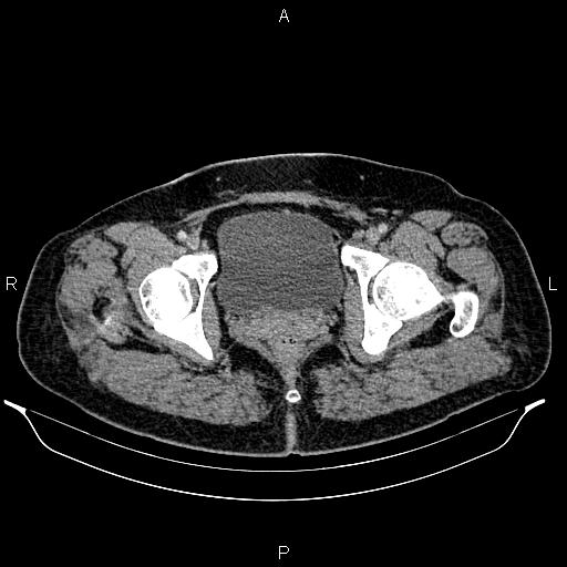 File:Bilateral ovarian dermoid cysts (Radiopaedia 85785-101603 A 104).jpg