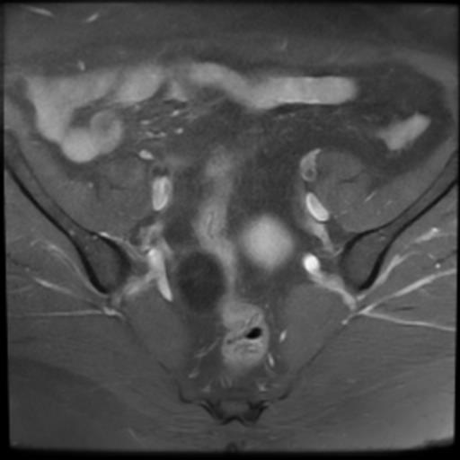 File:Bilateral ovarian dermoid cysts (Radiopaedia 90152-107338 Axial T1 C+ fat sat 7).jpg