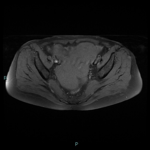File:Bilateral ovarian fibroma (Radiopaedia 44568-48293 Axial T1 fat sat 13).jpg