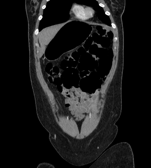 File:Bilateral ovarian mature cystic teratomas (Radiopaedia 79373-92457 B 6).jpg
