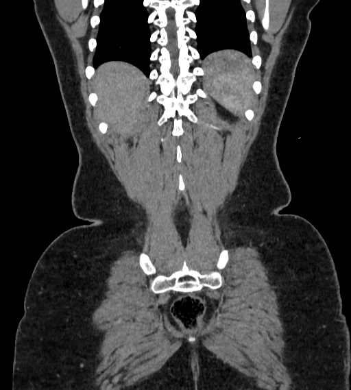 Bilateral ovarian mature cystic teratomas (Radiopaedia 79373-92457 B 98).jpg