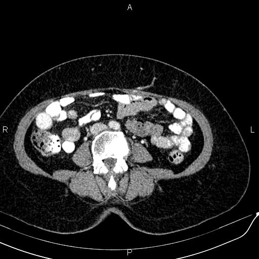 Bilateral ovarian serous cystadenocarcinoma (Radiopaedia 86062-101989 B 59).jpg
