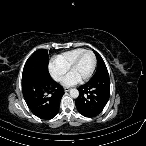 Bilateral ovarian serous cystadenocarcinoma (Radiopaedia 86062-101989 B 7).jpg