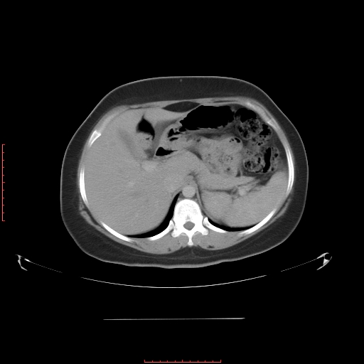 File:Bilateral ovarian serous cystadenocarcinoma with right ovarian torsion (Radiopaedia 32640-33611 A 10).jpg