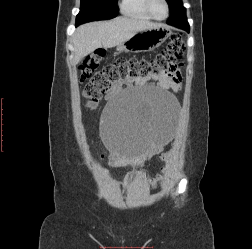 File:Bilateral ovarian serous cystadenocarcinoma with right ovarian torsion (Radiopaedia 32640-33611 B 7).jpg