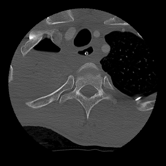 Bilateral perched facets with cord injury (Radiopaedia 45587-49713 Axial bone window 113).jpg