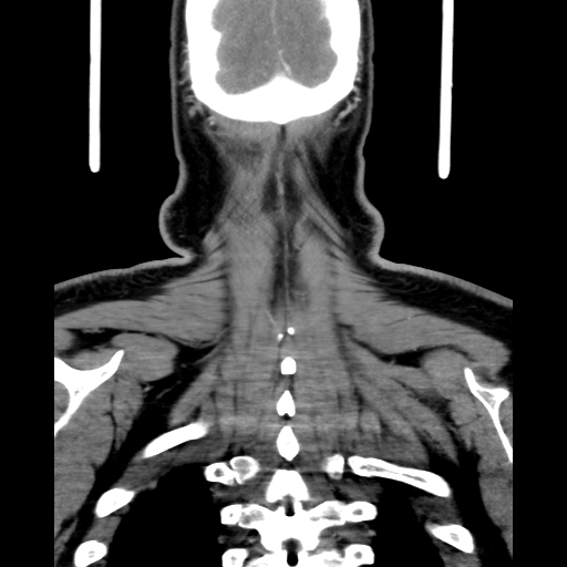 Bilateral peritonsillar abscess (Radiopaedia 85065-100610 Coronal 67).jpg