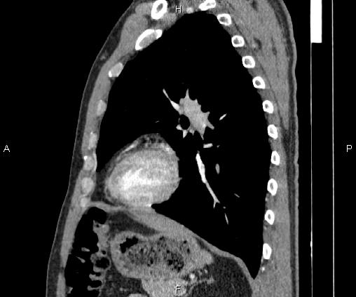 Bilateral pulmonary AVM (Radiopaedia 83134-97505 D 76).jpg