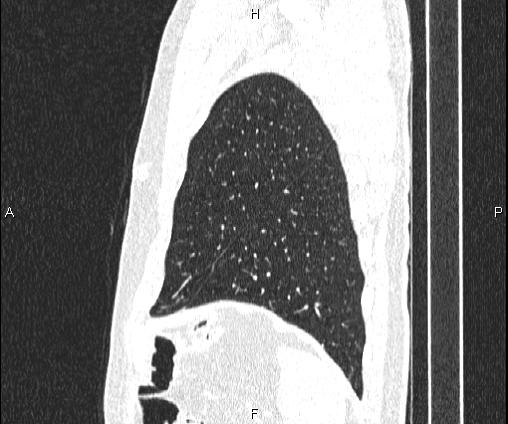 Bilateral pulmonary AVM (Radiopaedia 83134-97505 Sagittal lung window 96).jpg