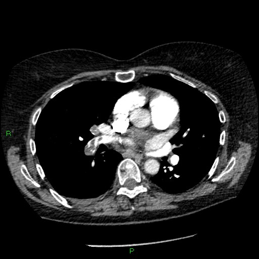 Bilateral pulmonary emboli (Radiopaedia 32700-33669 Axial C+ CTPA 55).jpg
