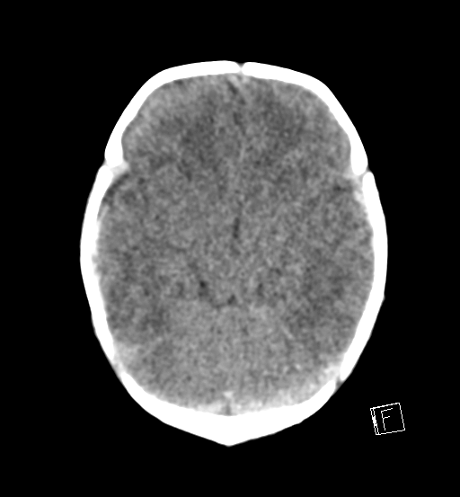 File:Bilateral subdural hemorrhage and parietal skull fracture (Radiopaedia 26058-26192 Axial non-contrast 16).png