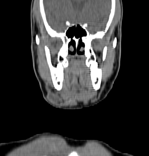 Bilateral submandibular sialolithiasis with sialadenitis (Radiopaedia 70721-80881 Coronal non-contrast 3).jpg