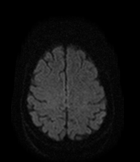 File:Bilateral thalamic glioma (Radiopaedia 65852-75009 Axial DWI 16).jpg