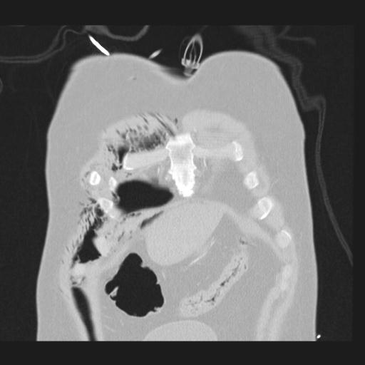 Bilateral traumatic renovascular injury (Radiopaedia 32051-32995 Coronal lung window 10).jpg