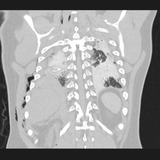 Bilateral traumatic renovascular injury (Radiopaedia 32051-32995 Coronal lung window 65).jpg