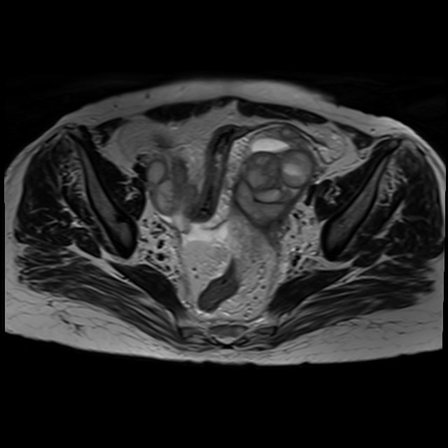 Bilateral tubo-ovarian abscesses (Radiopaedia 58635-65829 Axial T2 21).jpg