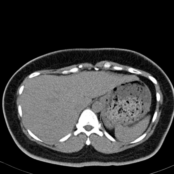 Bilateral ureteric stents (Radiopaedia 48795-53825 Axial non-contrast 6).jpg