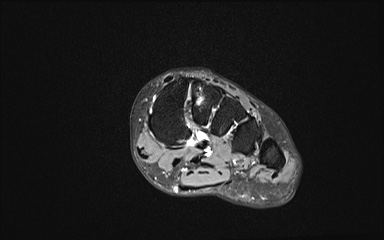 Bipartite hallux sesamoid diastasis (Radiopaedia 77133-89109 Coronal T2 fat sat 5).jpg