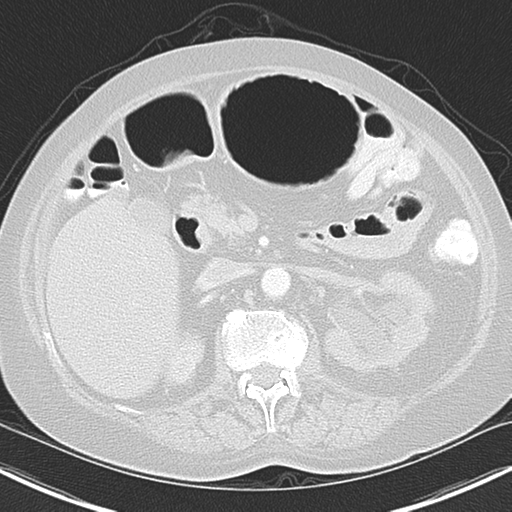 File:Bladder and bowel cancers (Radiopaedia 37688-39592 Axial lung window 59).png