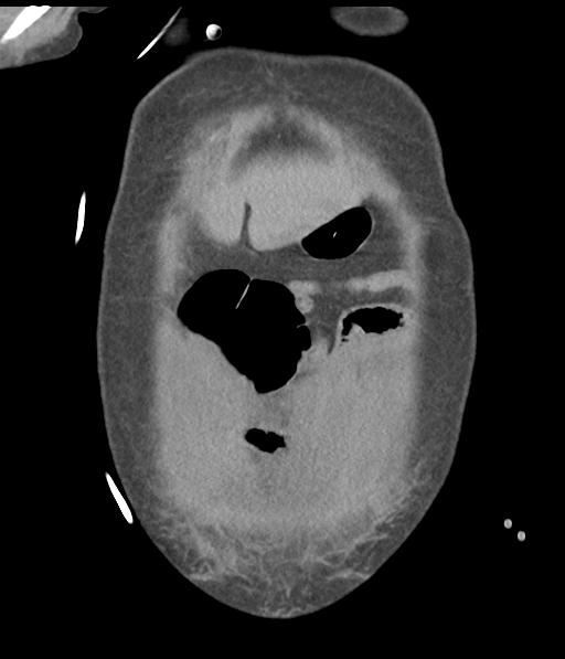 Bladder rupture post renal biopsy (Radiopaedia 30863-31572 Coronal non-contrast 11).jpg