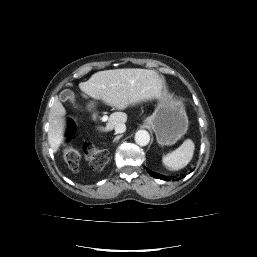 File:Bladder tumor detected on trauma CT (Radiopaedia 51809-57609 B 35).jpg