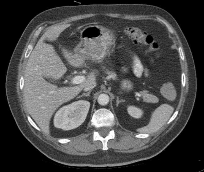 File:Bleeding duodenal ulcer and adenomyomatosis of gallbladder (Radiopaedia 61834-69861 A 31).jpg