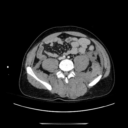 Blunt abdominal trauma with solid organ and musculoskelatal injury with active extravasation (Radiopaedia 68364-77895 A 101).jpg