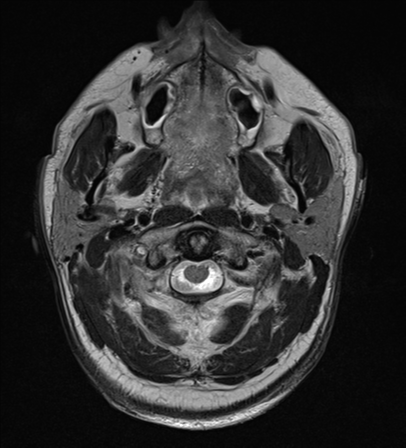 File:Blunt cerebrovascular injury (Radiopaedia 53682-59745 Axial T2 1).png