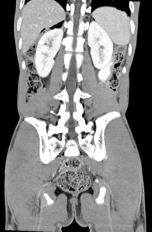 Blunt injury to the small bowel (Radiopaedia 74953-85987 B 72).jpg