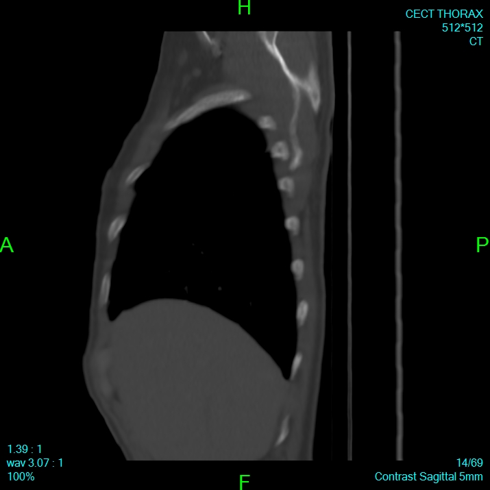 Bone metastases from lung carcinoma (Radiopaedia 54703-60937 Sagittal bone window 14).jpg