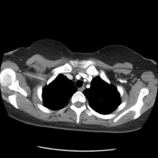 File:Borderline mucinous tumor (ovary) (Radiopaedia 78228-90808 A 10).jpg