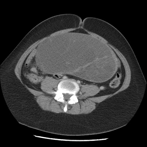 File:Borderline mucinous tumor (ovary) (Radiopaedia 78228-90808 A 104).jpg