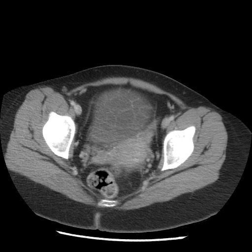 File:Borderline mucinous tumor (ovary) (Radiopaedia 78228-90808 A 130).jpg