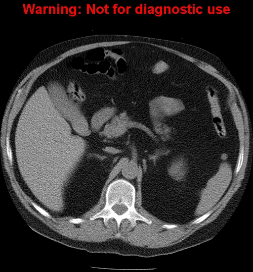 File:Bosniak renal cyst - type IV (Radiopaedia 23402-23466 Axial non-contrast 6).jpg