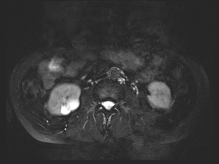 File:Bouveret syndrome (Radiopaedia 61017-68856 Axial MRCP 42).jpg