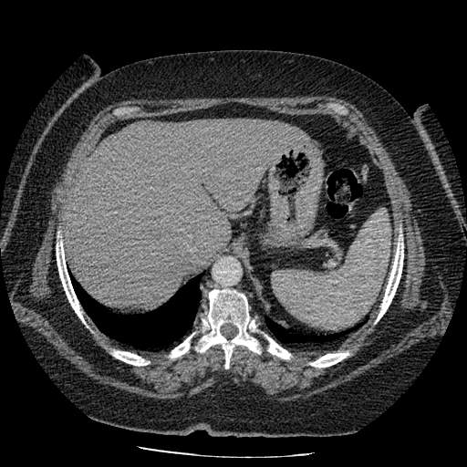 Bovine aortic arch - right internal mammary vein drains into the superior vena cava (Radiopaedia 63296-71875 A 153).jpg