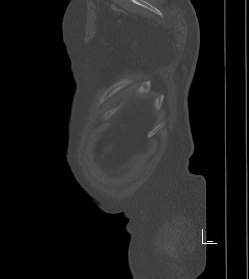 Bowel ischemia secondary to SMA occlusion with extensive portomesenteric venous gas (Radiopaedia 54656-60871 Sagittal bone window 4).jpg