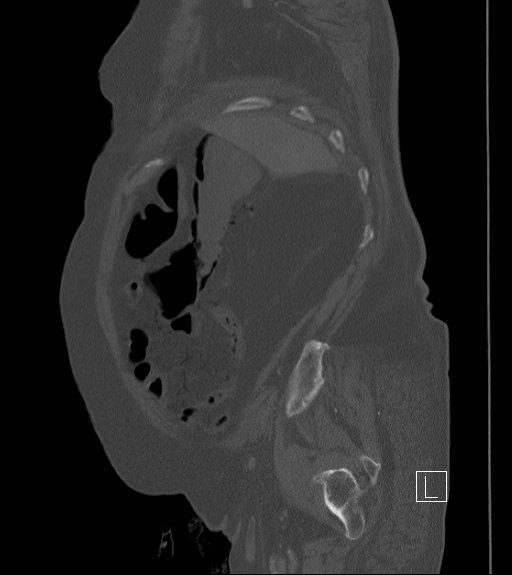 Bowel ischemia secondary to SMA occlusion with extensive portomesenteric venous gas (Radiopaedia 54656-60871 Sagittal bone window 96).jpg