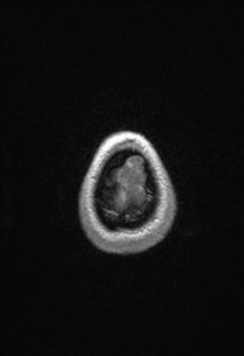 Brain abscess with ventriculitis (Radiopaedia 85703-101495 Axial T1 C+ 160).jpg