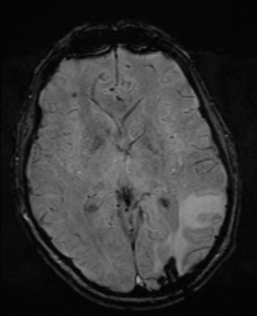Brain metastases - lung cancer primary (Radiopaedia 75060-86115 Axial SWI 32).jpg